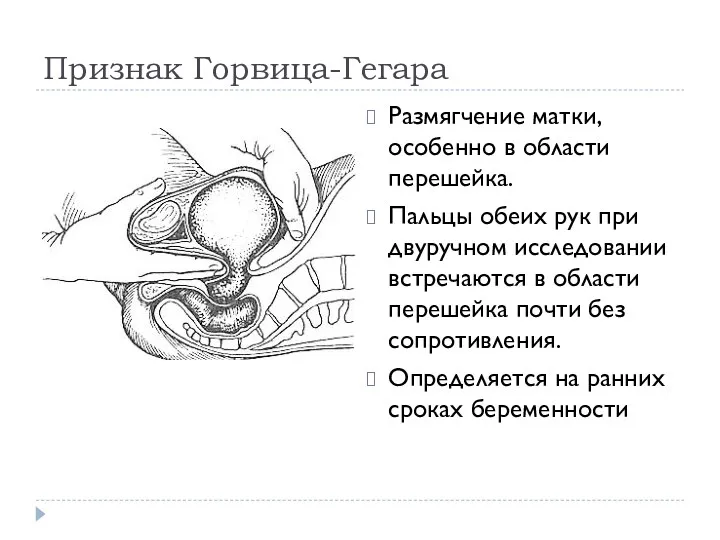 Признак Горвица-Гегара Размягчение матки, особенно в области перешейка. Пальцы обеих