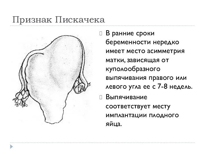 Признак Пискачека В ранние сроки беременности нередко имеет место асимметрия