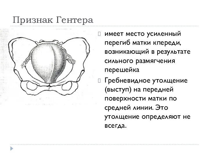 Признак Гентера имеет место усиленный перегиб матки кпереди, возникающий в