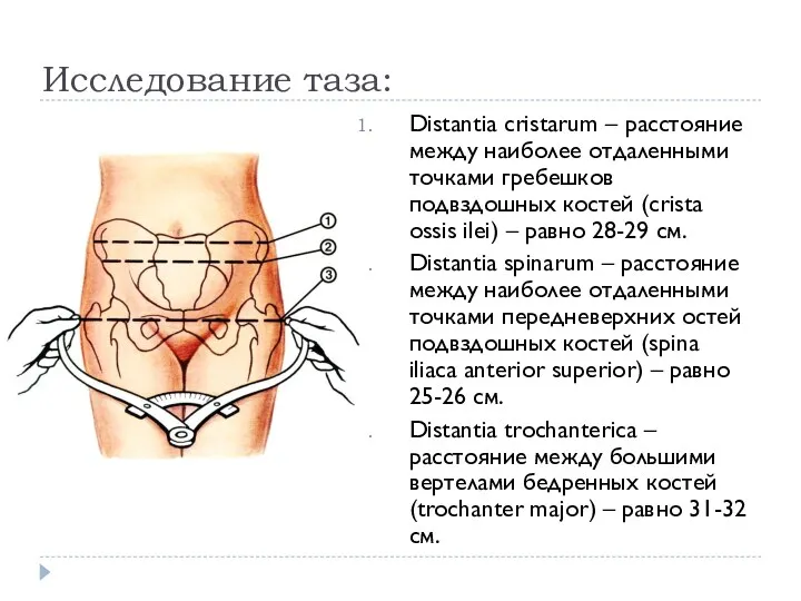 Исследование таза: Distantia cristarum – расстояние между наиболее отдаленными точками