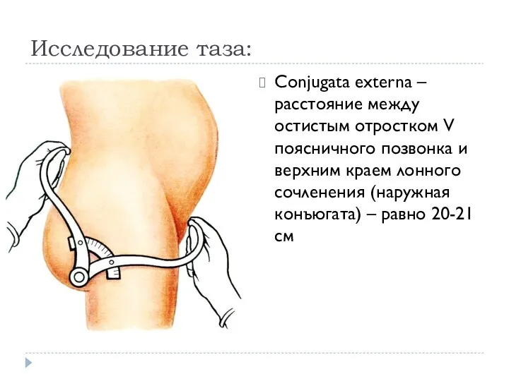 Исследование таза: Conjugata externa – расстояние между остистым отростком V