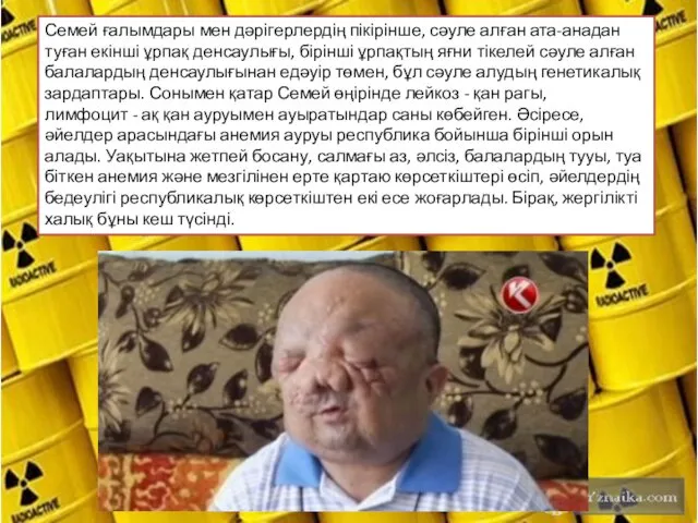 Семей ғалымдары мен дәрігерлердің пікірінше, сәуле алған ата-анадан туған екінші