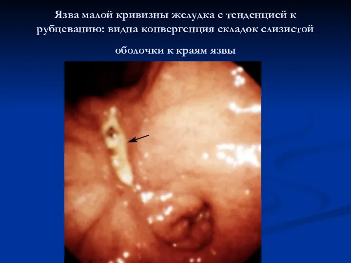 Язва малой кривизны желудка с тенденцией к рубцеванию: видна конвергенция складок слизистой оболочки к краям язвы