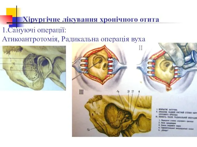 Хірургічне лікування хронічного отита 1.Сануючі операції: Атикоантротомія, Радикальна операція вуха