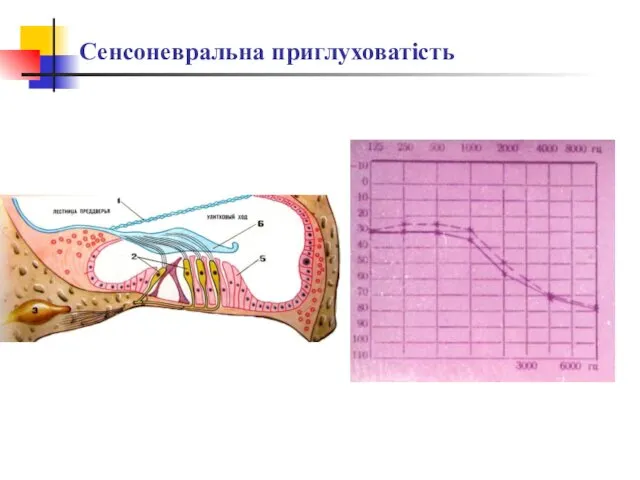 Сенсоневральна приглуховатість