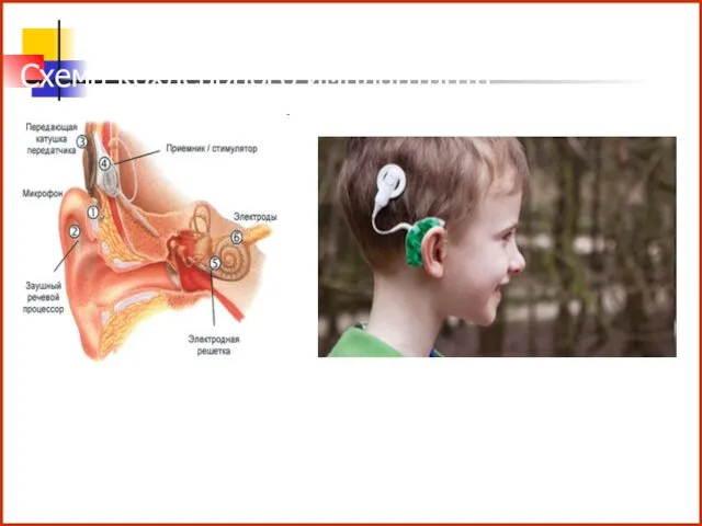 Схема кохлеарного имплантанта