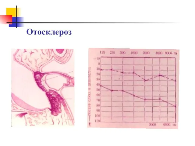 Отосклероз