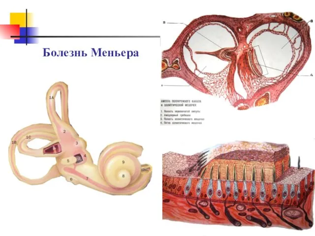 Болезнь Меньера