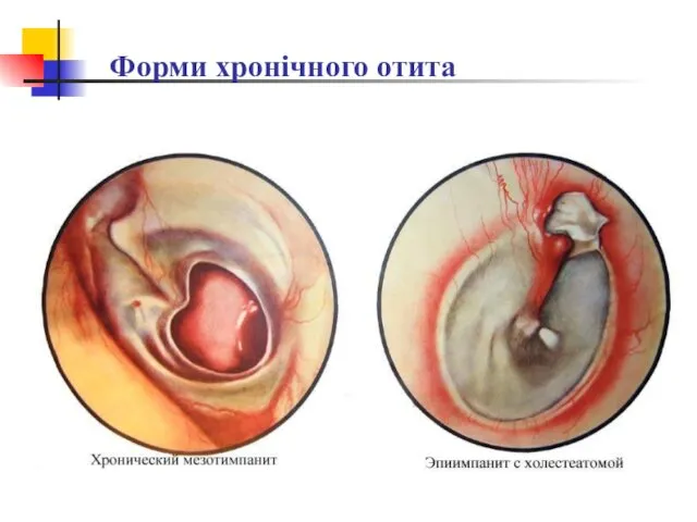 Форми хронічного отита