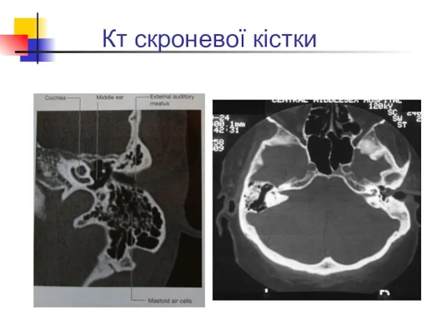 Кт скроневої кістки