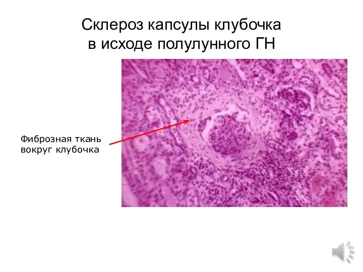 Склероз капсулы клубочка в исходе полулунного ГН Фиброзная ткань вокруг клубочка