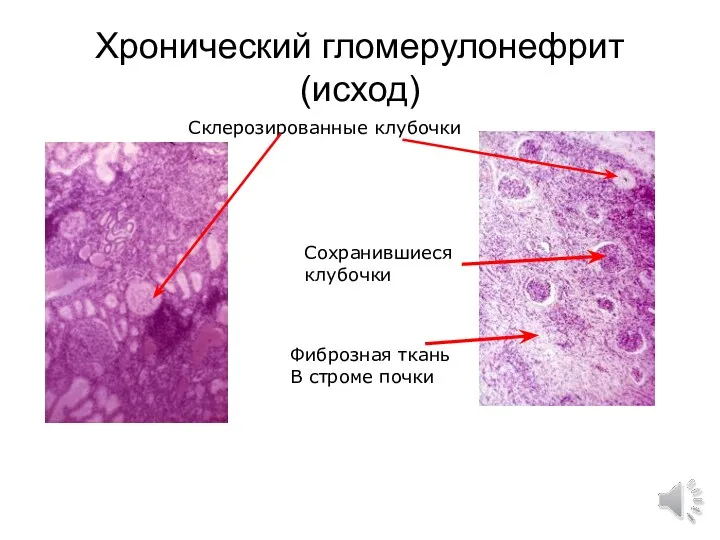 Хронический гломерулонефрит (исход) Склерозированные клубочки Сохранившиеся клубочки Фиброзная ткань В строме почки