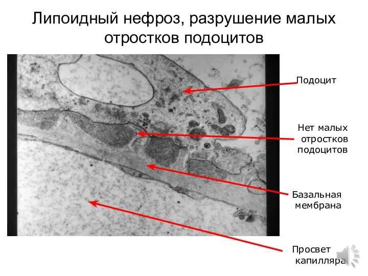 Липоидный нефроз, разрушение малых отростков подоцитов Подоцит Базальная мембрана Просвет капилляра Нет малых отростков подоцитов