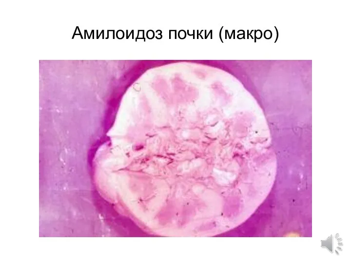 Амилоидоз почки (макро)
