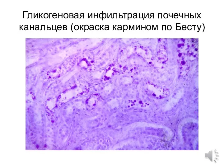 Гликогеновая инфильтрация почечных канальцев (окраска кармином по Бесту)