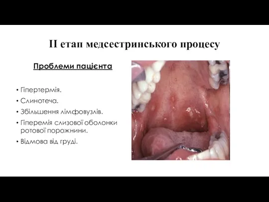 ІІ етап медсестринського процесу Проблеми пацієнта Гіпертермія. Слинотеча. Збільшення лімфовузлів.