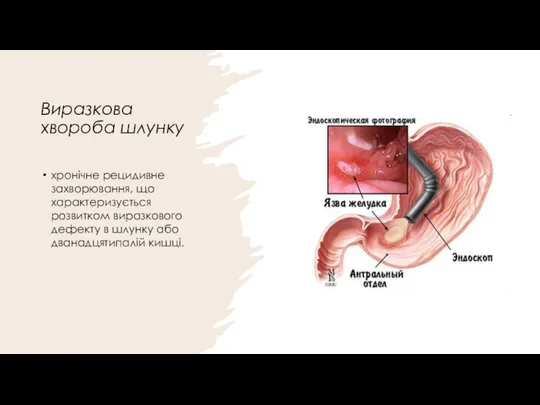 Виразкова хвороба шлунку хронічне рецидивне захворювання, що характеризується розвитком виразкового дефекту в шлунку або дванадцятипалій кишці.