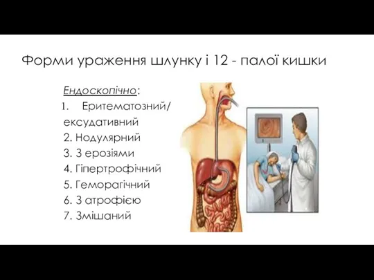 Форми ураження шлунку і 12 - палої кишки Ендоскопічно: Еритематозний/