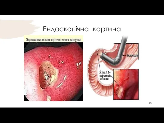 Ендоскопічна картина