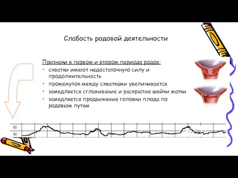 Слабость родовой деятельности Признаки в первом и втором периоде родов: