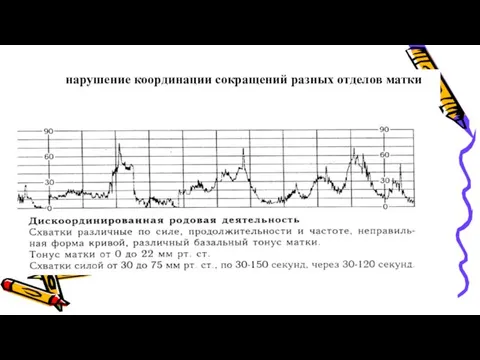 нарушение координации сокращений разных отделов матки