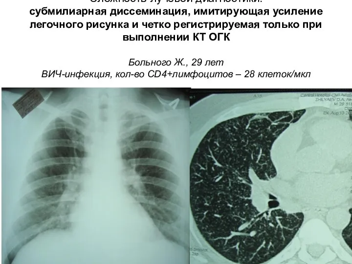 Сложность лучевой диагностики: субмилиарная диссеминация, имитирующая усиление легочного рисунка и