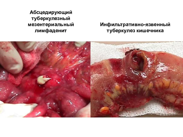 Абсцедирующий туберкулезный мезентериальный лимфаденит Инфильтративно-язвенный туберкулез кишечника