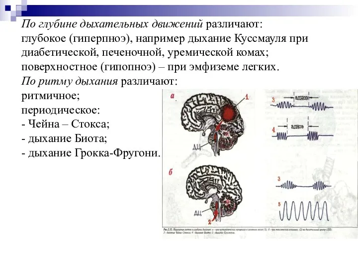 По глубине дыхательных движений различают: глубокое (гиперпноэ), например дыхание Кусcмауля