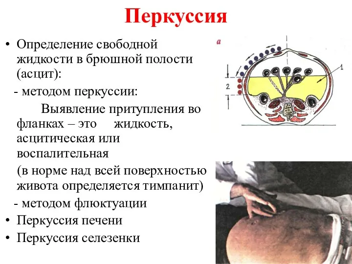 Перкуссия Определение свободной жидкости в брюшной полости (асцит): - методом