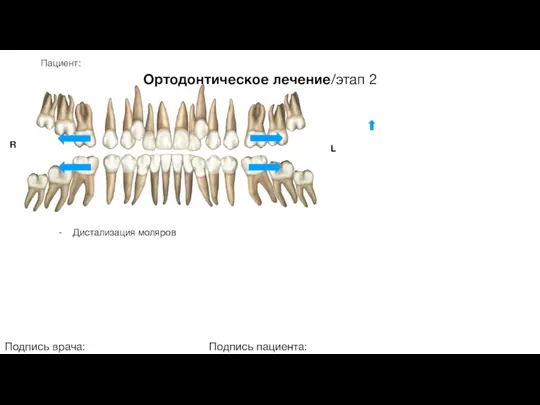 Пациент: Ортодонтическое лечение/этап 2 Подпись врача: Подпись пациента: R L - Дистализация моляров