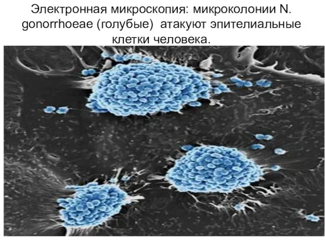 Электронная микроскопия: микроколонии N. gonorrhoeae (голубые) атакуют эпителиальные клетки человека.