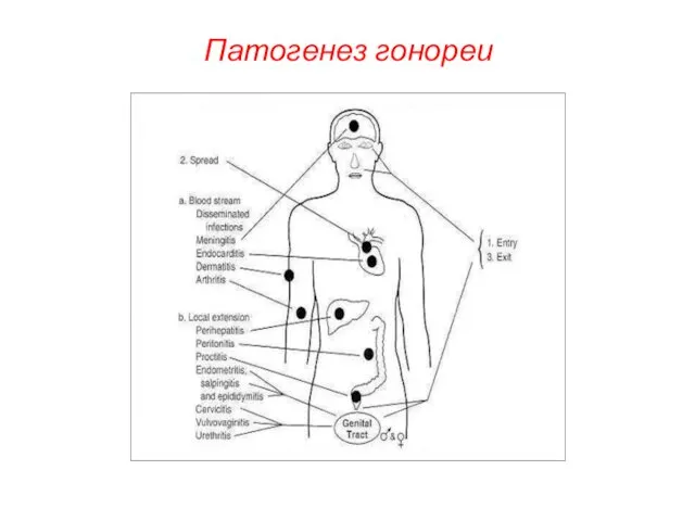 Патогенез гонореи