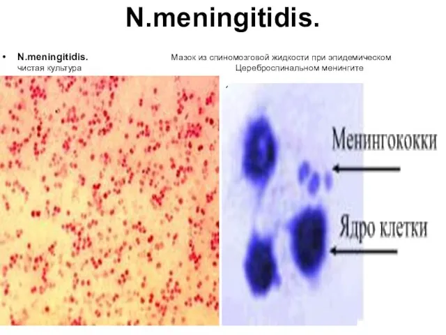 N.meningitidis. N.meningitidis. Мазок из спиномозговой жидкости при эпидемическом чистая культура Цереброспинальном менингите окраска