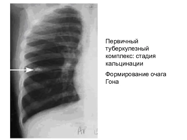 Первичный туберкулезный комплекс: стадия кальцинации Формирование очага Гона