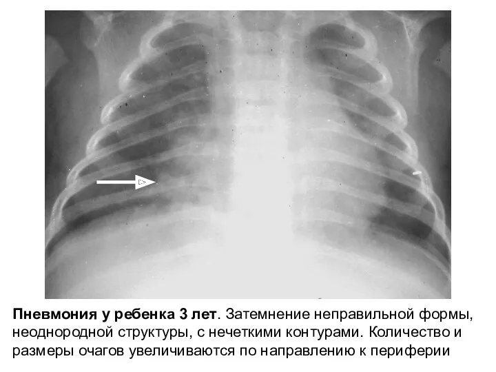 Пневмония у ребенка 3 лет. Затемнение неправильной формы, неоднородной структуры,