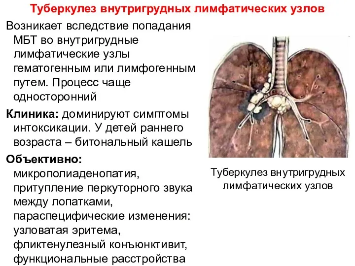 Туберкулез внутригрудных лимфатических узлов Возникает вследствие попадания МБТ во внутригрудные