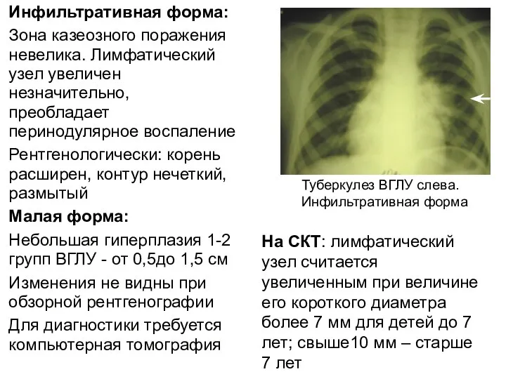 Инфильтративная форма: Зона казеозного поражения невелика. Лимфатический узел увеличен незначительно,