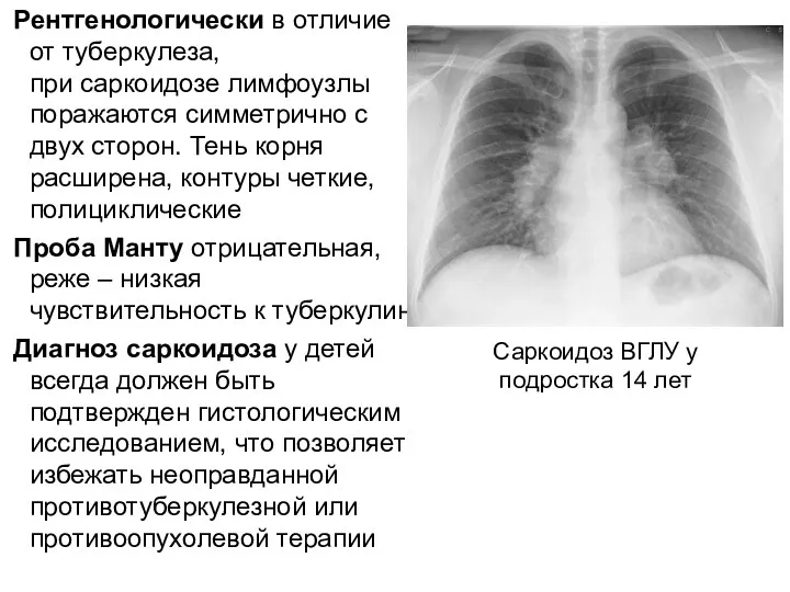 Рентгенологически в отличие от туберкулеза, при саркоидозе лимфоузлы поражаются симметрично