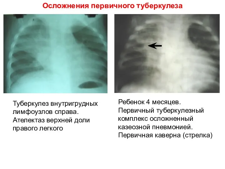 Осложнения первичного туберкулеза Туберкулез внутригрудных лимфоузлов справа. Ателектаз верхней доли