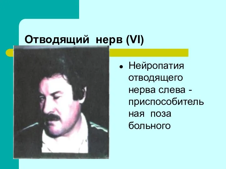 Отводящий нерв (VI) Нейропатия отводящего нерва слева - приспособительная поза больного