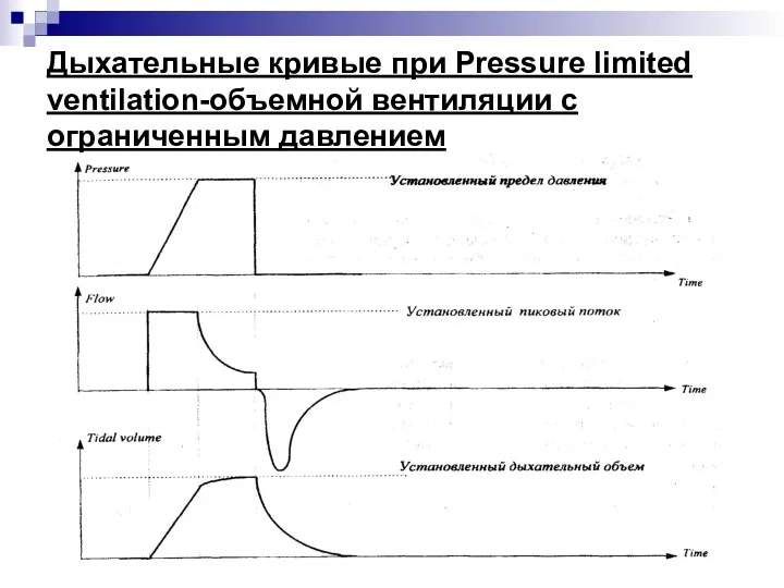 Дыхательные кривые при Pressure limited ventilation-объемной вентиляции с ограниченным давлением