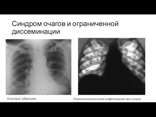 Синдром очагов и ограниченной диссеминации Очаговый туберкулез Очаги воспалительной инфильтрации при острой пневмонии