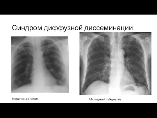 Синдром диффузной диссеминации Метастазы в легкие Милиарный туберкулез