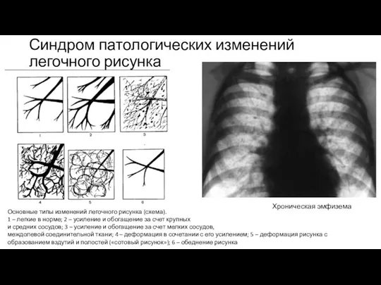 Синдром патологических изменений легочного рисунка Хроническая эмфизема Основные типы изменений