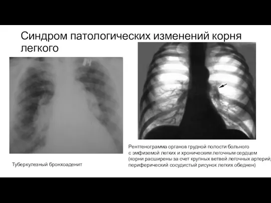 Синдром патологических изменений корня легкого Туберкулезный бронхоаденит Рентгенограмма органов грудной