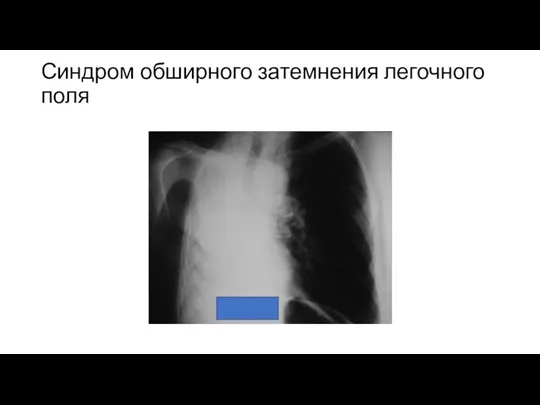 Синдром обширного затемнения легочного поля