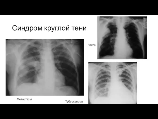 Синдром круглой тени Метастазы Туберкулома Киста