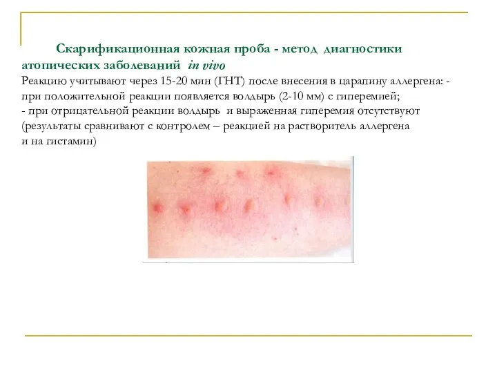 Скарификационная кожная проба - метод диагностики атопических заболеваний in vivo