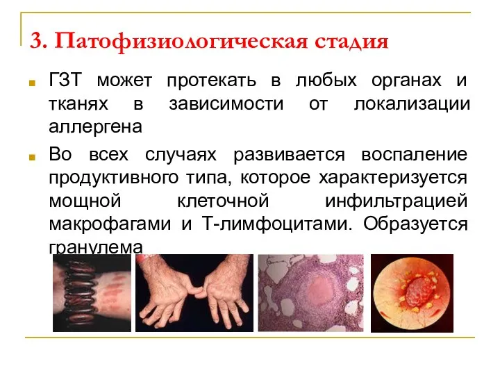 3. Патофизиологическая стадия ГЗТ может протекать в любых органах и