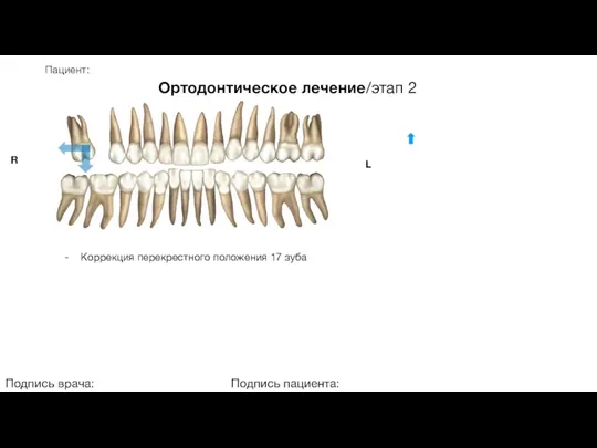 Пациент: Ортодонтическое лечение/этап 2 Подпись врача: Подпись пациента: R L - Коррекция перекрестного положения 17 зуба